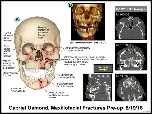 3D skull model with annotated maxillofacial fractures and corresponding CT images highlighting various bone injuries.