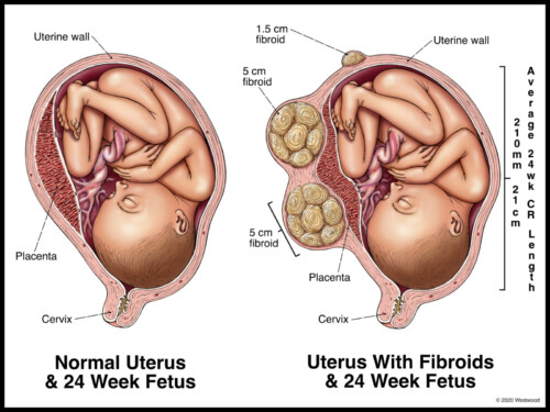 Illustration comparing a normal uterus and a uterus with fibroids, each containing a 24-week fetus.