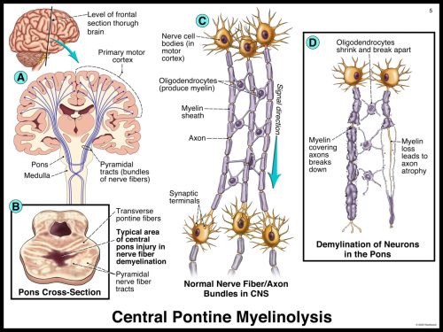 Diagram illustrating central pontine myelinolysis with brain and nerve fiber images, highlighting neuron damage and demyelination.