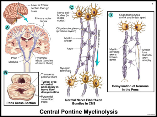 Diagram illustrating central pontine myelinolysis with brain and nerve fiber images, highlighting neuron damage and demyelination.
