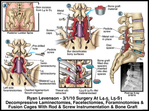 Medical illustration of lumbar spine surgery showing laminectomies, facets, foraminotomies, and bone graft placement.