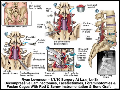 Medical illustration of lumbar spine surgery showing laminectomies, facets, foraminotomies, and bone graft placement.