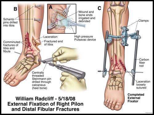 Diagram showing the procedure for external fixation of right pilon and distal fibular fractures using surgical devices.
