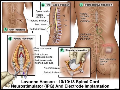 Illustration of spinal cord neurostimulator implantation, showing skin incisions, paddle placement, and stimulator insertion.