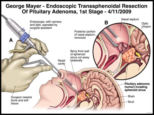 Illustration of endoscopic transsphenoidal resection of pituitary adenoma with labeled parts and surgical process details.