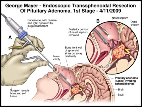 Illustration of endoscopic transsphenoidal resection of pituitary adenoma with labeled parts and surgical process details.