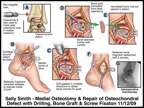 Step-by-step illustration of medial osteotomy and osteochondral repair procedure with drilling, bone graft, and screw fixation.