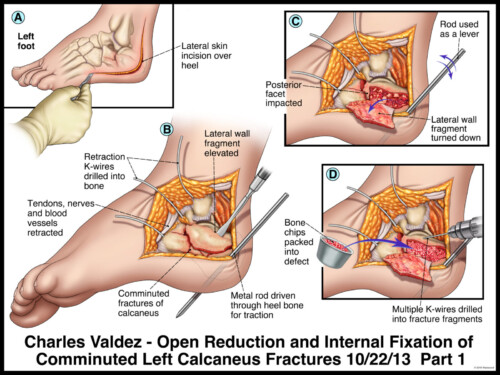 Medical illustration of open reduction and fixation of comminuted left calcaneus fractures, showing incision and fixation steps.