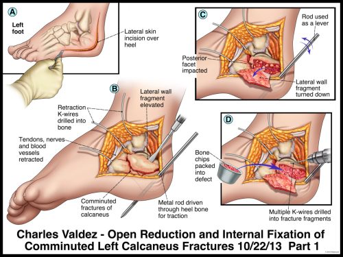 Medical illustration of open reduction and fixation of comminuted left calcaneus fractures, showing incision and fixation steps.