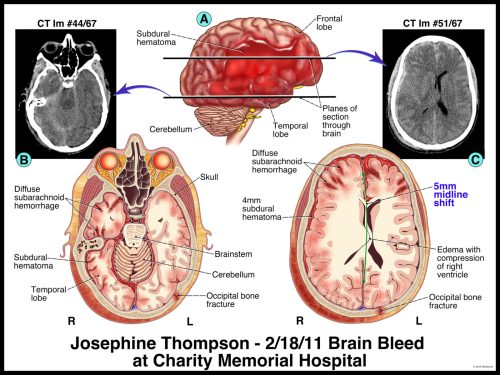 Medical illustration of brain bleed showing CT scans, cross-sections of the brain, and labeled hematomas and fractures.